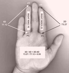 2D-4D Ratio